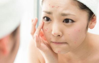 Nguyên nhân gây nổi mụn trong kỳ kinh nguyệt